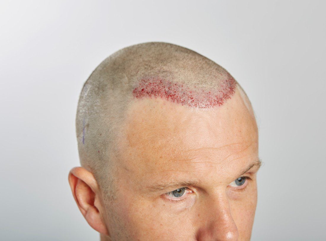 20180604_hshc_0112 Immediately post op – 618 FU grafts via FUE extraction