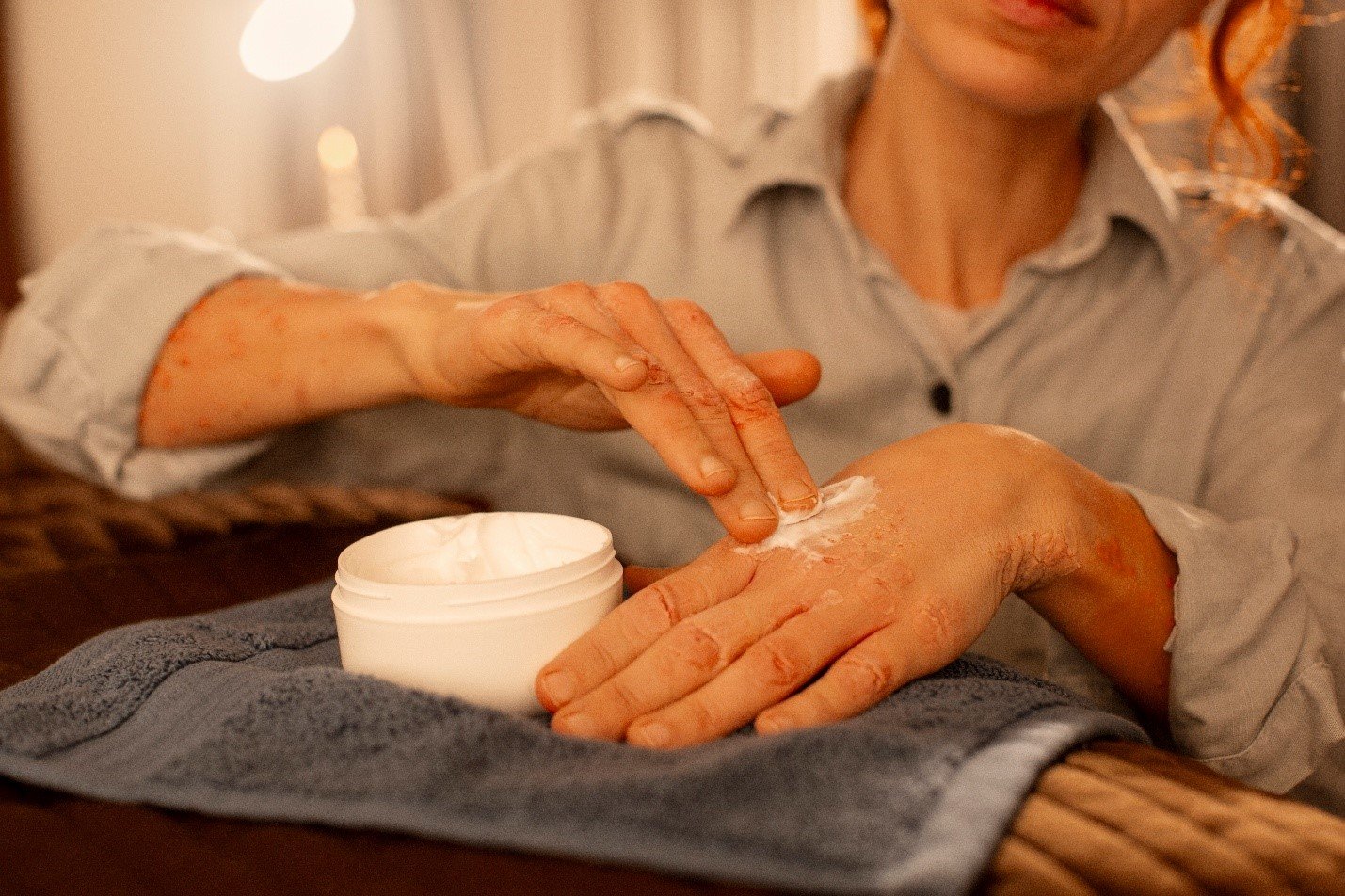 How Do You Treat Senile Purpura in Elderly Skin